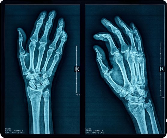 X-ray scan of human hand. (Source: © PhotoEdit / stock.adobe.com)